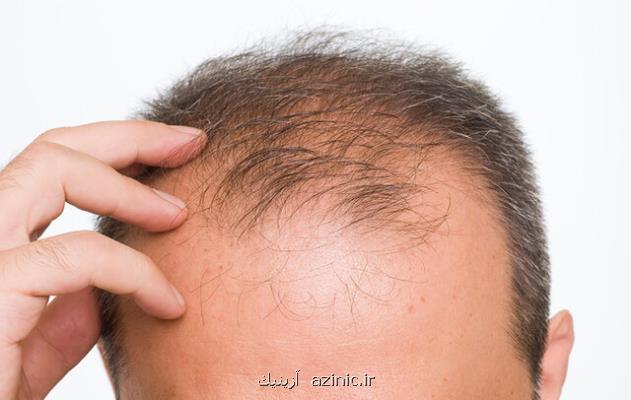 یک عامل تشدیدکننده ریزش مو در مردان