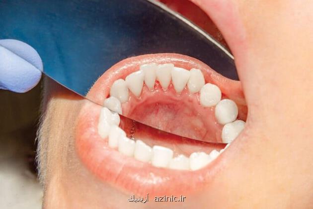 علایم شایع سرطان دهان