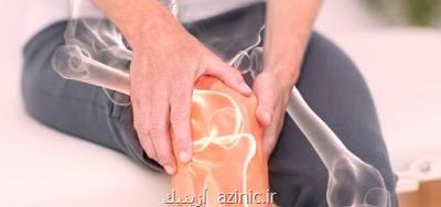 بهبود سریعتر عملكرد زانو در مبتلایان آرتروز زانو با كمك سلول های بنیادی