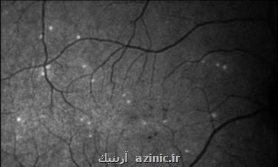 هوش مصنوعی بیماری چشمی را پیشبینی می كند